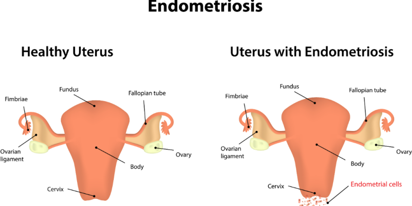 A diagram of a healthy uterus vs one with endometriosis
