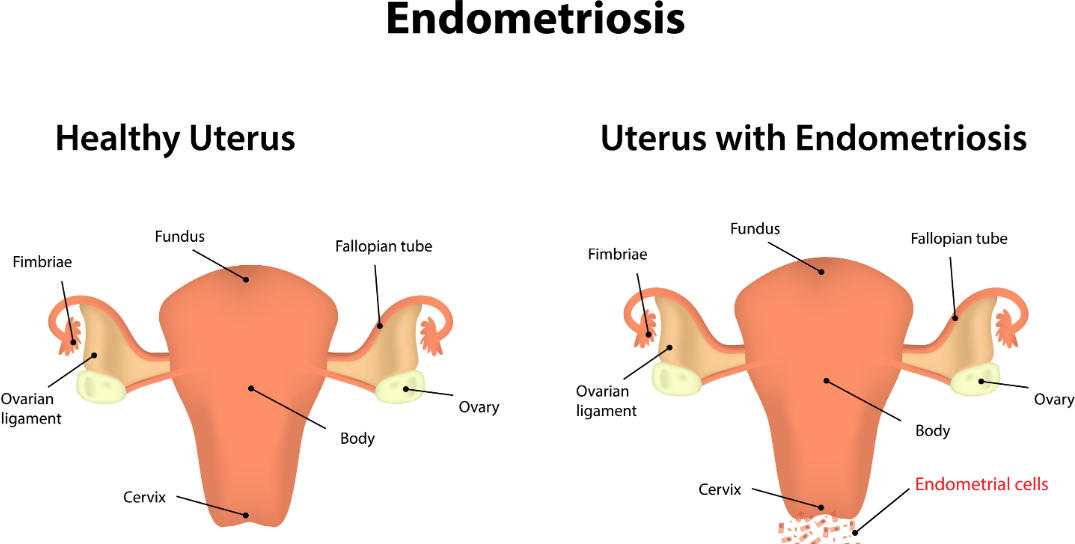 A diagram of a healthy uterus vs one with endometriosis